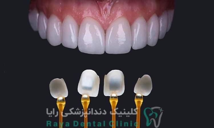  عمر لمینیت دندان