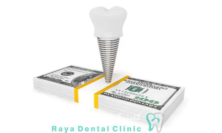 هزینه ایمپلنت برای هر فک 