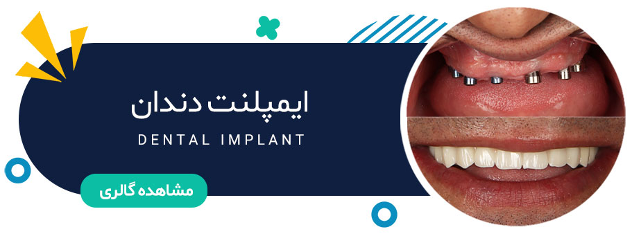 نمونه کار ایمپلنت دندان