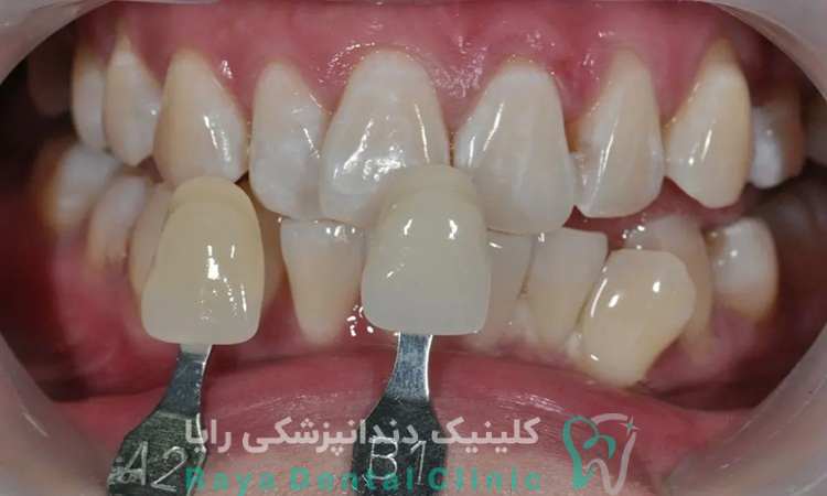  کاندیدای لمینیت فوری