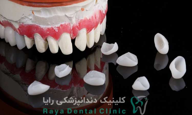 لمینیت فوری دندان چیست 