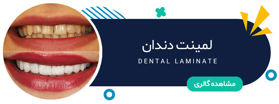 نمونه کار لمینت دندان