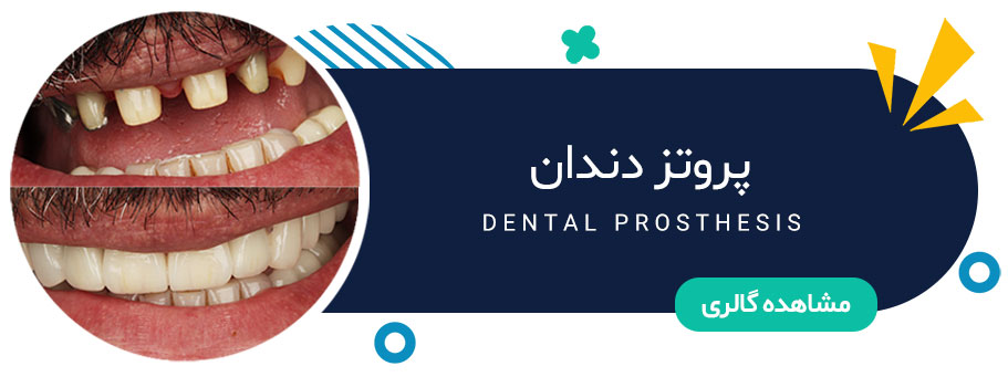نمونه کار پروتز دندان