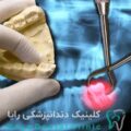 کشیدن دندان عقل جراحی