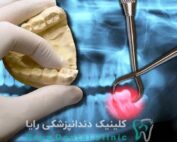 کشیدن دندان عقل جراحی