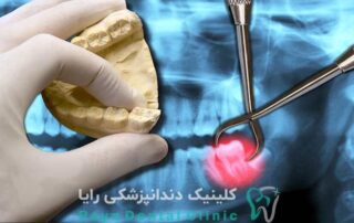 کشیدن دندان عقل جراحی