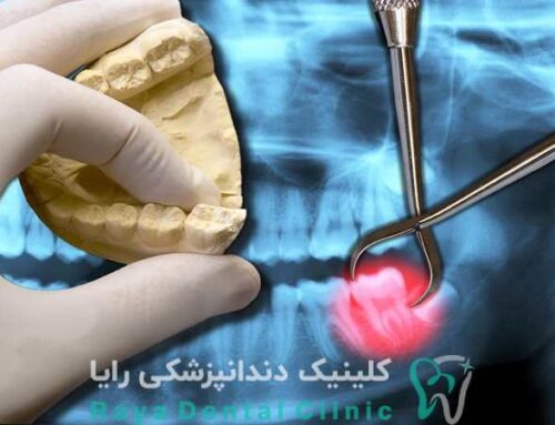 مراحل و مراقبت‌ های بعد از کشیدن دندان عقل جراحی