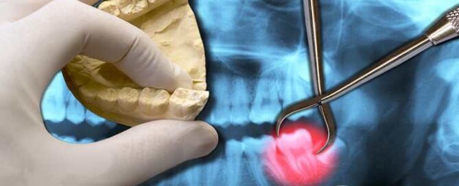 کشیدن دندان عقل جراحی