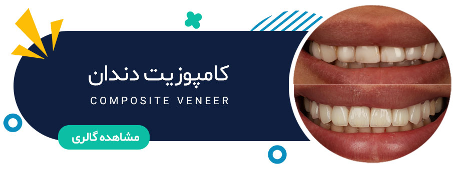 نمونه کار کامپوزیت دندان