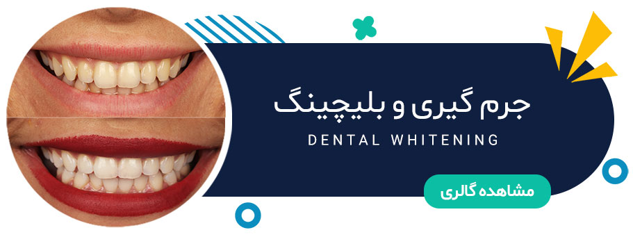 نمونه کار بلیچینگ دندان