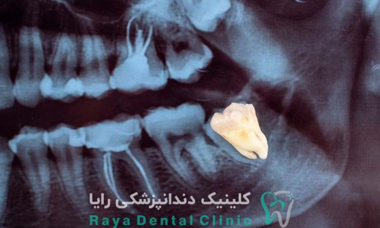 جراحی دندان عقل