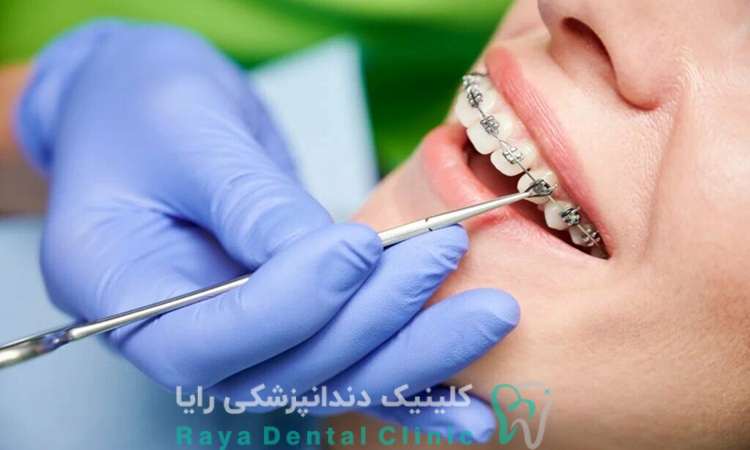 دوام و اثربخشی پلاک ها