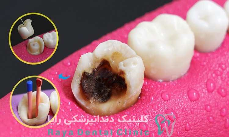 عصب کشی دندان 