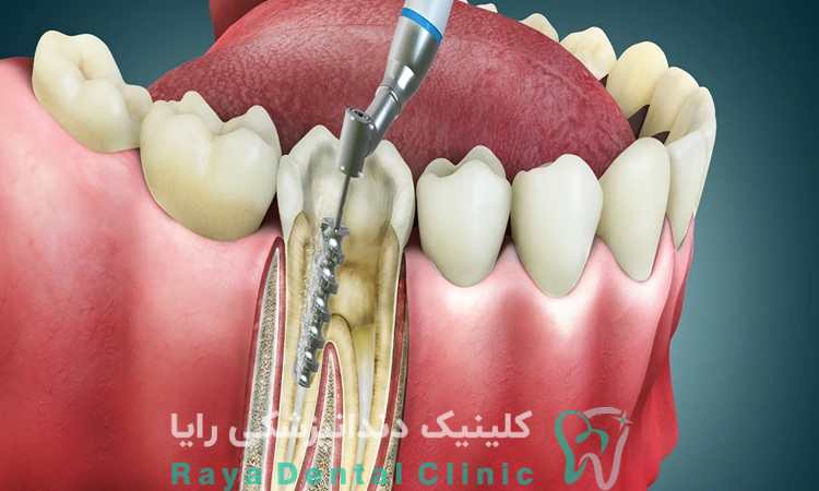 مزایای عصب کشی دندان شکسته