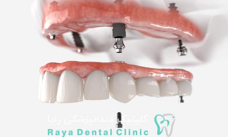 نکات مراقبتی پس از جراحی ایمپلنت