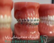 انتخاب بهترین نوع ارتودنسی