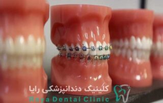 انتخاب بهترین نوع ارتودنسی