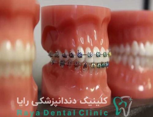 راهنمای کامل انتخاب بهترین نوع ارتودنسی برای شما