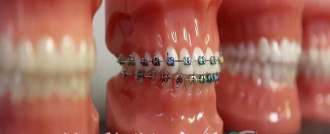 انتخاب بهترین نوع ارتودنسی