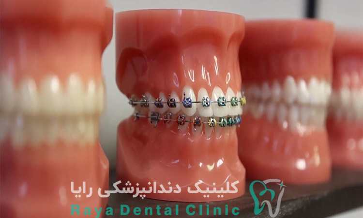 انتخاب بهترین نوع ارتودنسی