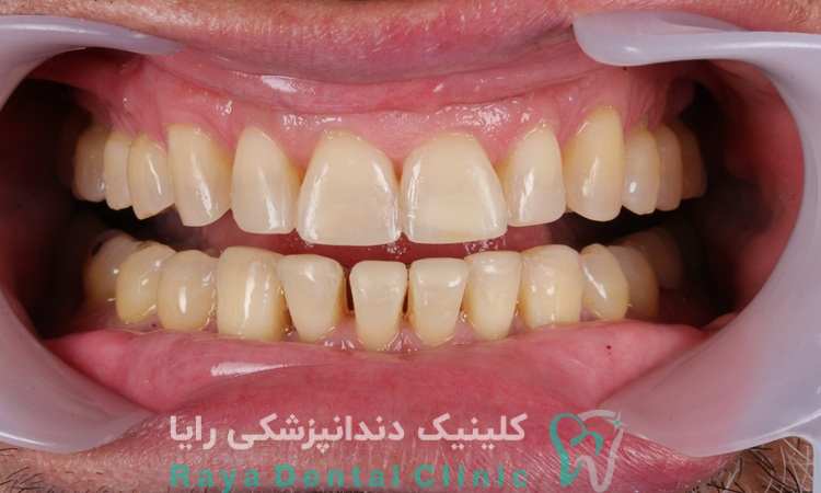 ترمیم به موقع کامپوزیت