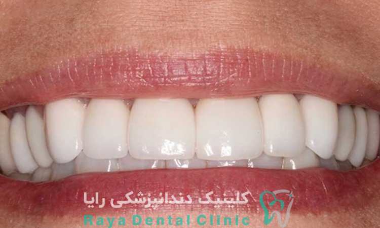 افزایش عمر کامپوزیت دندان