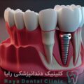 بهترین دندانپزشک ایمپلنت
