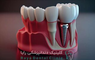بهترین دندانپزشک ایمپلنت