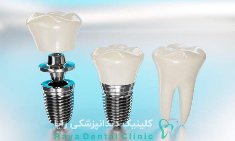 هزینه ایمپلنت دندان در تهران