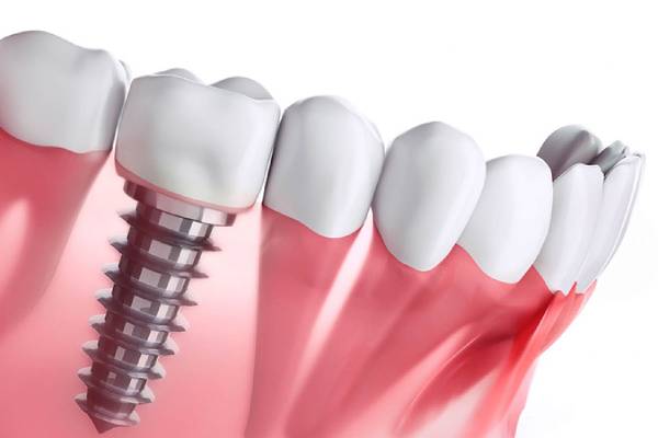dental-implant ایمپلنت دندان