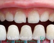 افزایش عمر کامپوزیت