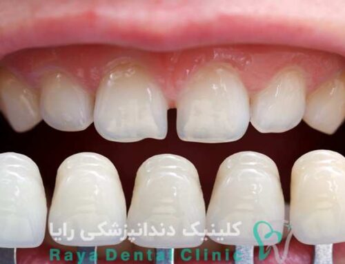 توصیه‌ های دندانپزشکان برای افزایش عمر کامپوزیت