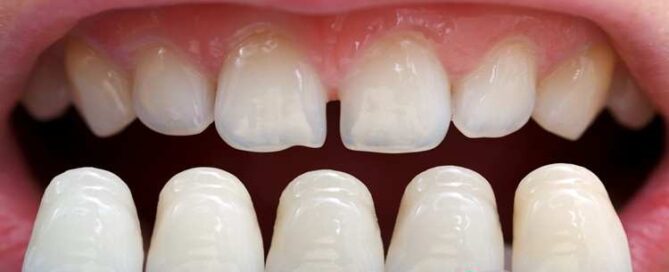 افزایش عمر کامپوزیت