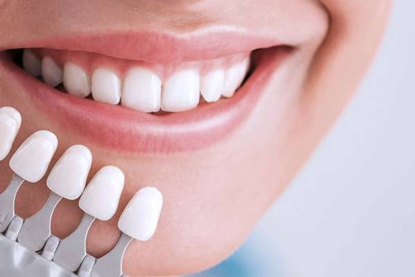 teeth laminate لمینت دندان
