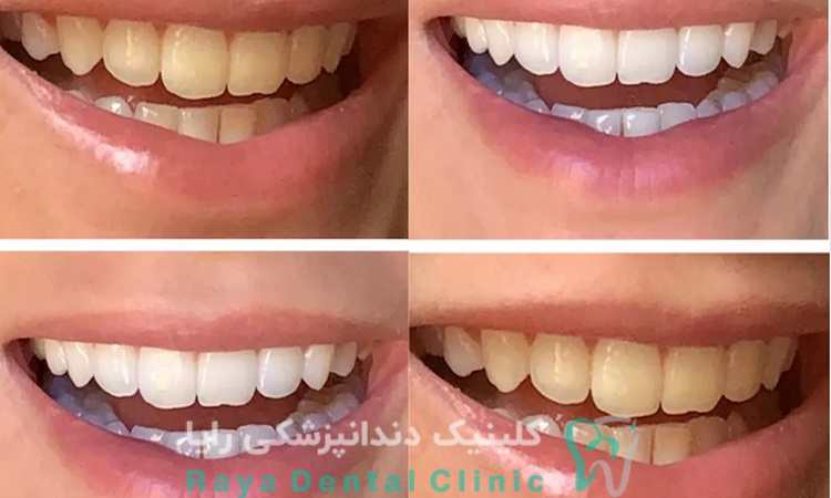 جلوگیری از حساسیت دندان