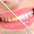 راهکارهای سفید کردن دندان