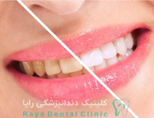 راهکارهای پیشرفته سفید کردن دندان ها بدون آسیب به مینای دندان