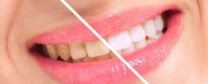 راهکارهای سفید کردن دندان