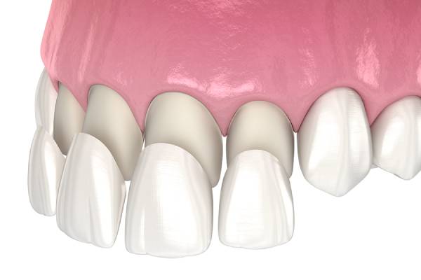 veneers_composite ونیر کامپوزیت