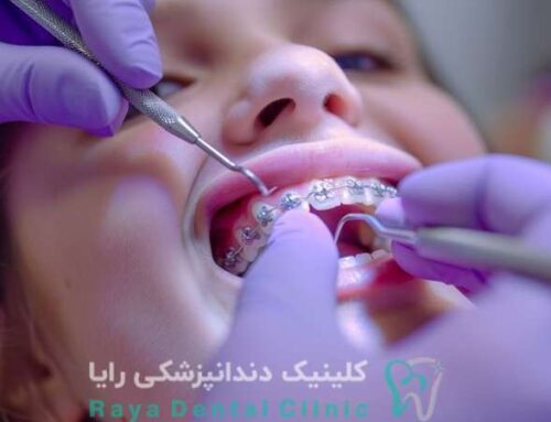 اصلاح عادات مکیدن انگشت با پلاک های پیشگیری ارتودنسی