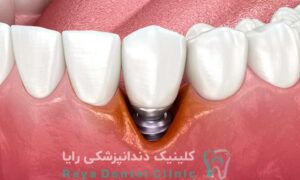 ایمپلنت اشترومن