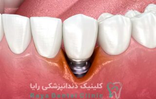 ایمپلنت اشترومن