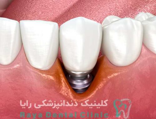 ایمپلنت اشترومن با کاهش زمان بهبود پس از جراحی