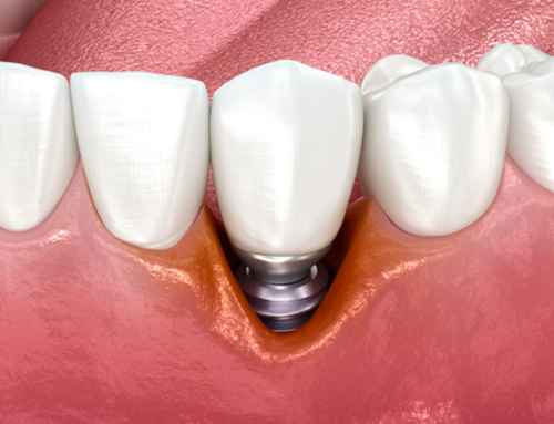 ایمپلنت اشترومن با کاهش زمان بهبود پس از جراحی