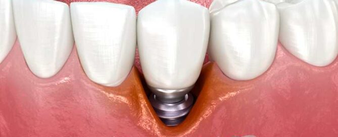 ایمپلنت اشترومن