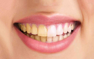 بلیچینگ با لیزر