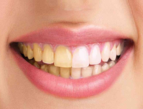 بلیچینگ با لیزر برای سفید شدن سریع و ایمن