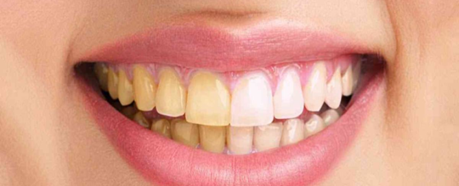 بلیچینگ با لیزر