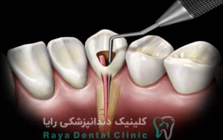 عصب کشی دندان