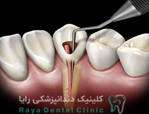 عصب کشی دندان شکسته با ترمیم فوری تاج